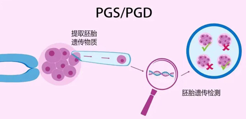 PGS胚胎移植前遗传学筛查