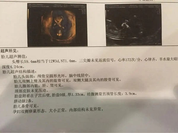 孕13周NT报告单出现了这三个亮点是在告诉你胎儿的性别