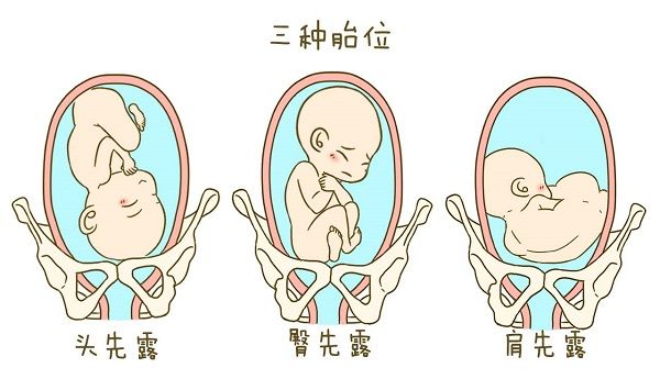 胎动位置与胎位图解