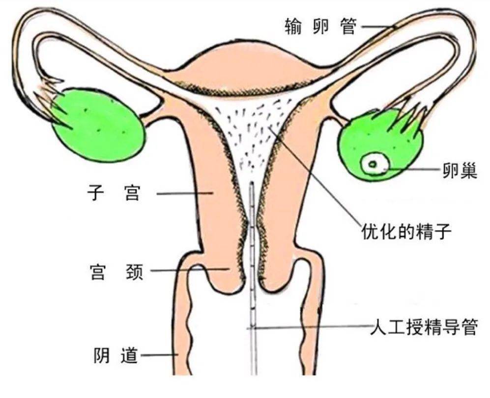 做人工受孕需要什么条件?附治疗全流程介绍