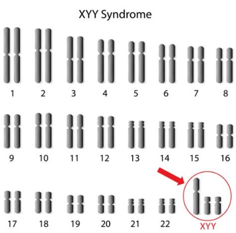 染色体异常可以生出正常的小孩吗？三代试管成为首选