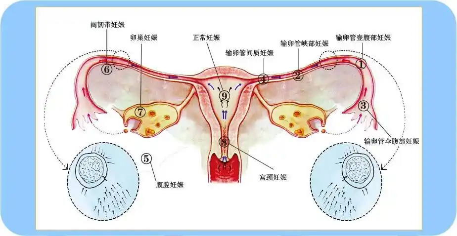 分享宫外孕早期常见的六个征兆，如有发现需尽快就医