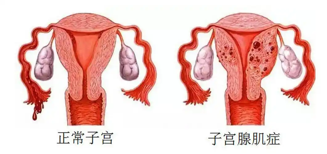 腺肌症患者尝试做试管婴儿的成功率高吗？