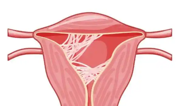 宫腔粘连可以怀孕吗?一个典型的试管案例告诉你答案