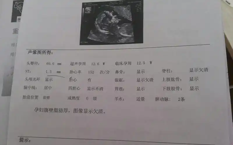 NT报告单显示三个亮点其实是在暗示你胎儿的性别