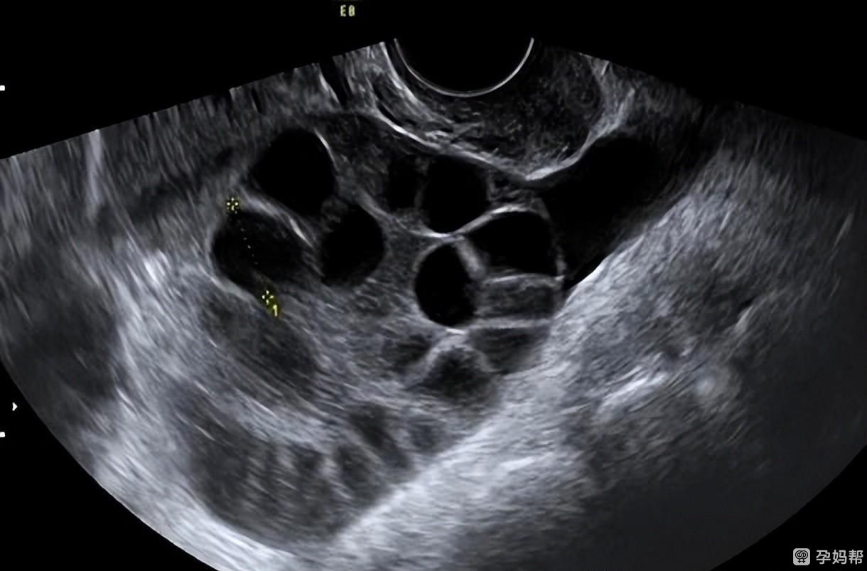 卵巢增大的现象